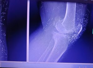 महिला के जोड़ों में मिला सैकड़ों सोने की सुइयां?